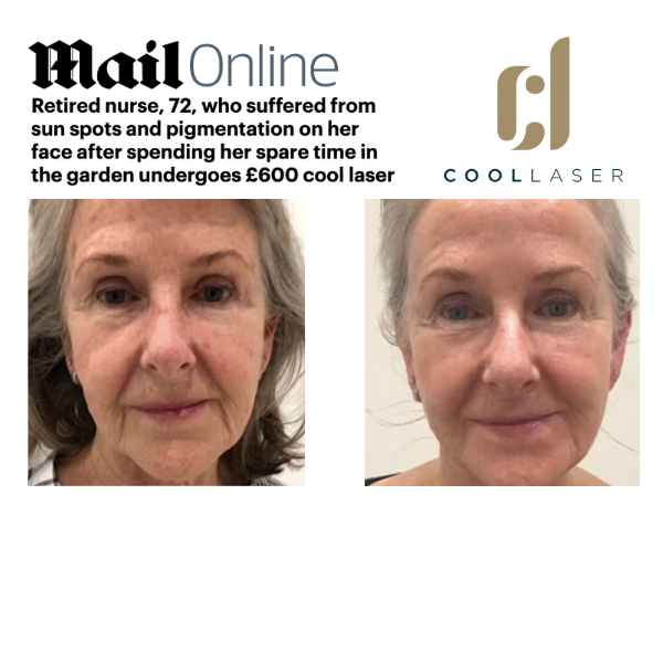 Daily Mail - Cool Laser: Retired nurse, 72, who suffered from sun spots and pigmentation on her face after spending her spare time in the garden undergoes £600 cool laser treatment which experts liken to a 'facelift without going under the knife'
