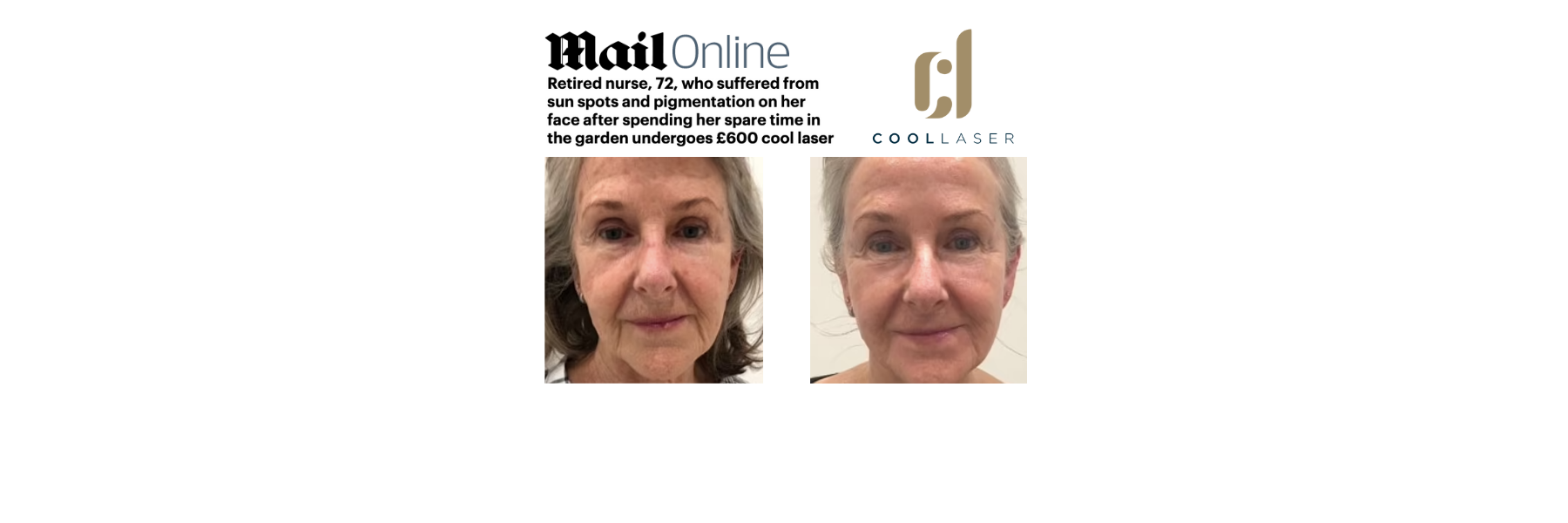Retired nurse, 72, who suffered from sun spots and pigmentation on her face after spending her spare time in the garden undergoes £600 cool laser treatment which experts liken to a 'facelift without going under the knife'
