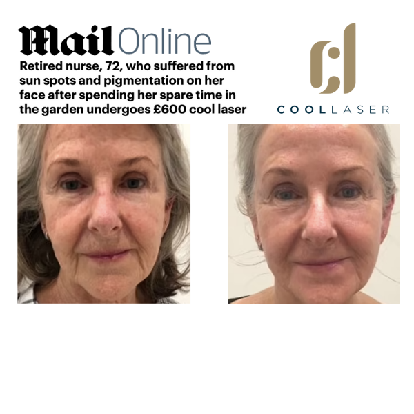 Retired nurse, 72, who suffered from sun spots and pigmentation on her face after spending her spare time in the garden undergoes £600 cool laser treatment which experts liken to a 'facelift without going under the knife'