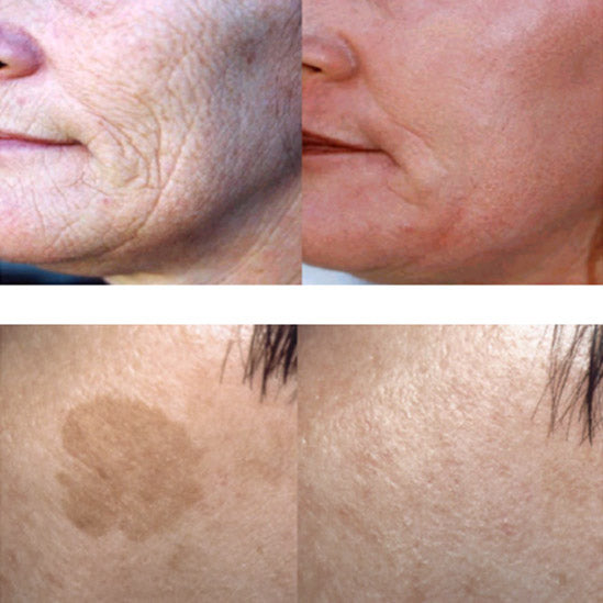 What Dual Wave Actually Does, And Why It Matters For RF Microneedling