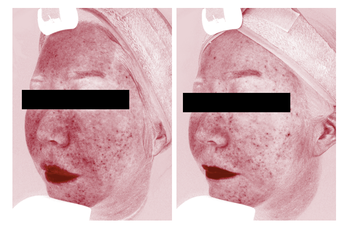 Before and After Sylfirm X - 1 treatment